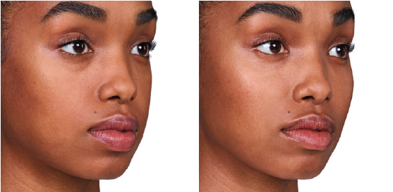 Before & after results of Juvederm voluma XC.