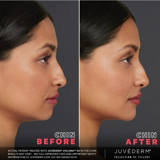 Before & after results of Juvederm voluma XC.